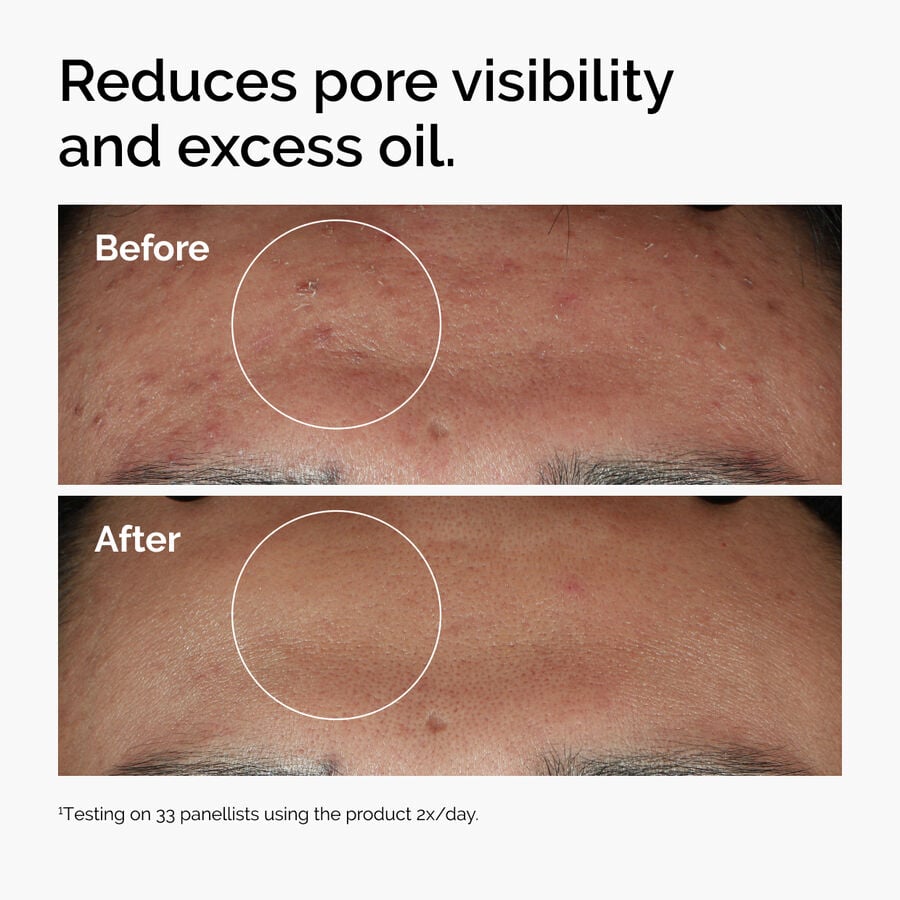 Before and after using Niacinamide 10% + Zinc 1% to reduce oil and minimize pores.