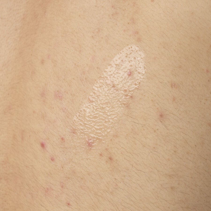 Close-up texture shot of Salicylic Acid 0.5% Body Serum. The clear, lightweight gel is shown applied directly to skin with some visible body acne, demonstrating its consistency.